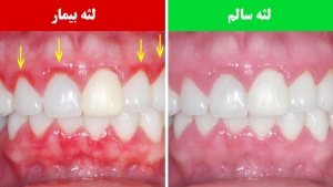لثه سالم و لثه بیمار