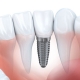 Dental implant
