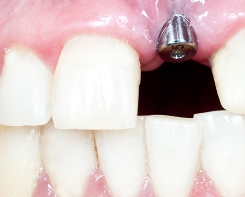 dental implant