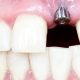 dental implant