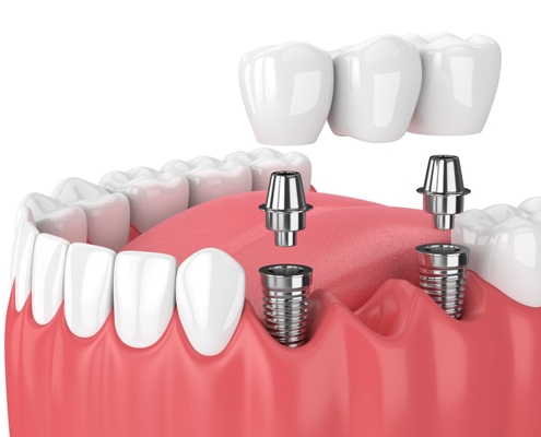 ایمپلنت دندان چقدر درد دارد - درد ایمپلنت دندان - دکتر شهرام جلیل زاده متخصص ایمپلنت دندان در رشت