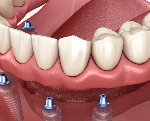ایمپلنت دندان چند جلسه طول میکشد؟ - دکتر شهرام جلیل زاده متخصص ایمپلنت در رشت - متخصص جراحی لثه در رشت