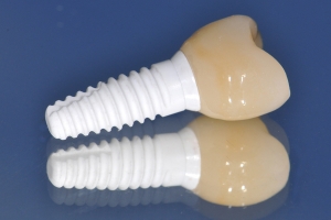 روکش ایمپلنت دندان سرامیکی - دکتر شهرام جلیل زاده - متخصص ایمپلنت در رشت و گیلان