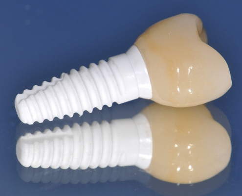 روکش ایمپلنت دندان سرامیکی - دکتر شهرام جلیل زاده - متخصص ایمپلنت در رشت و گیلان