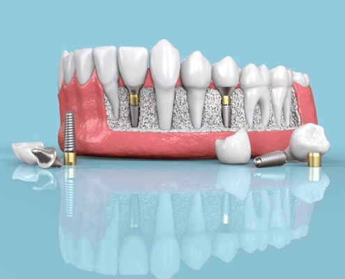 هزینه ایمپلنت دیجیتال دندان - ایمپلنت دیجیتالی چیست؟ - دکتر شهرام جلیل زاده متخصص ایمپلنت دندان در رشت و گیلان