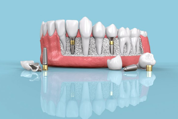 هزینه ایمپلنت دیجیتال دندان - ایمپلنت دیجیتالی چیست؟ - دکتر شهرام جلیل زاده متخصص ایمپلنت دندان در رشت و گیلان