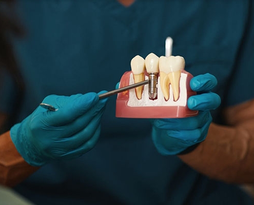 چه کسانی گزینه مناسبی برای ایمپلنت نیستند