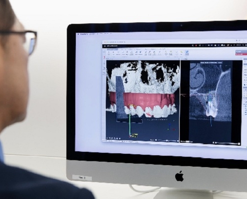 ایمپلنت دیجیتال دندان
