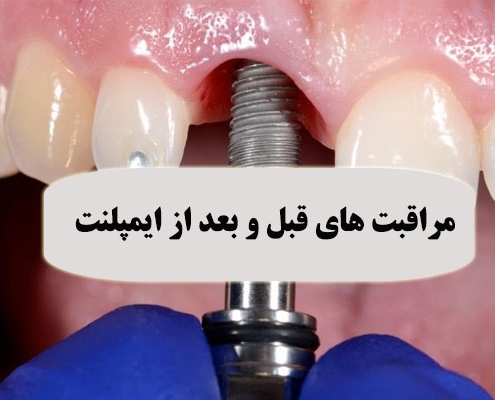 مراقبت های قبل و بعد از ایمپلنت دندان