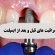 مراقبت های قبل و بعد از ایمپلنت دندان