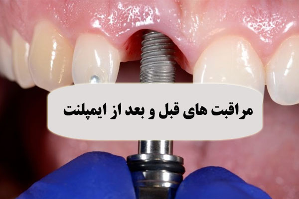 مراقبت های قبل و بعد از ایمپلنت دندان
