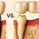مقایسه ایمپلنت و بریج