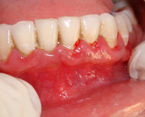 بیماری لثه
